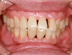 Closeup of smile with receeding gums