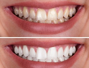 A woman’s smile before and after teeth whitening