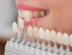 Smile compared with tooth shade chart