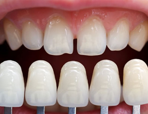 Closeup of teeth compared with color shading chart