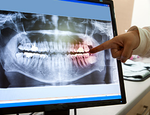 Panoramic dental x-rays on computer