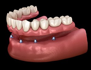 implant-retained denture illustration