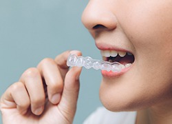 An up-close view of a person inserting an Invisalign aligner into their mouth in Herndon