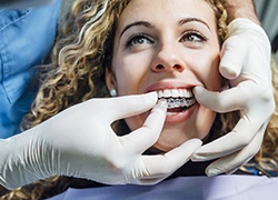 A young woman allowing a dentist to insert a clear aligner into her mouth during a fitting in Herndon