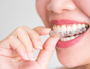 Invisalign can correct a variety of bite problems including overbites and underbites