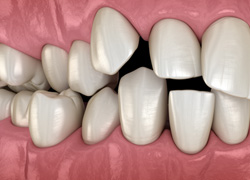 Invisalign can help straighten out crowded teeth