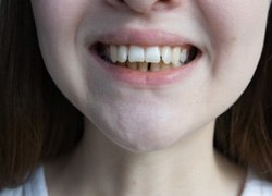 Invisalign may be able to correct your overbite
