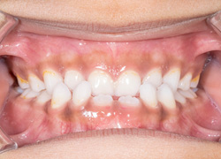 Invisalign can help resolve a crossbite