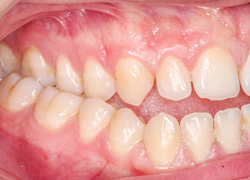 Close an open bite with Invisalign aligners