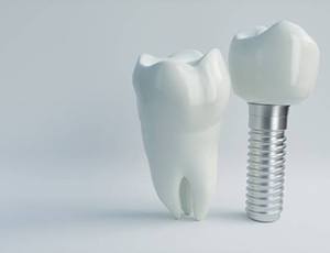 natural tooth next to a dental implant in Herndon