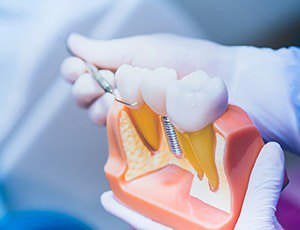 dentist showing a patient a dental implant model