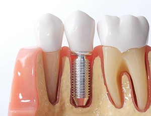 model of a dental implant