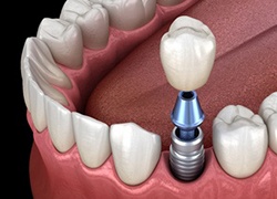 dental implant, abutment, and crown being placed in the lower jaw