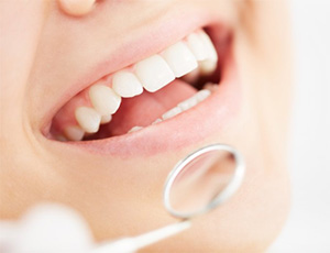 A closeup of a mouth during a dental exam.