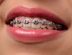 Smile with traditional braces