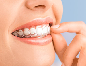 Woman placing Invisalign tray