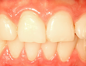 Closeup of healthy teeth and gums