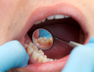 Closeup of smile during dental exam