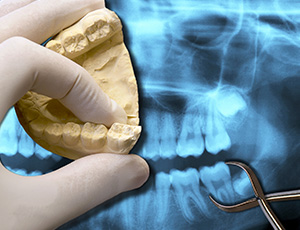 Model smile and x-rays of wisdom teeth