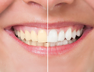 Closeup of smile half before and half after whitening