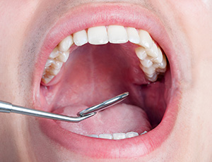 Closeup of smile during dental exam