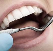 Closeup of teeth during dental exam