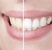 Closeup of teeth before and after whitening