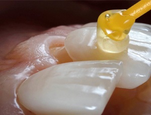 dentist placing porcelain veneers on a tooth