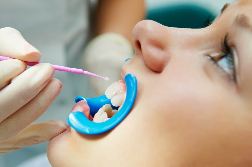 6 Things You Should Know About Dental Sealants Premier