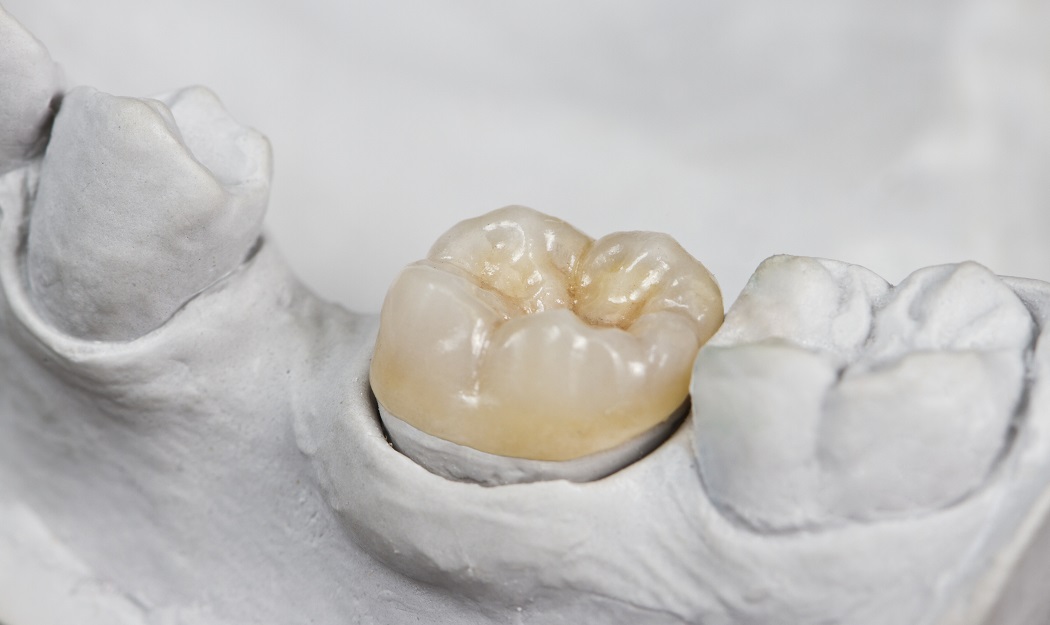 How Much Does a Dental Crown Cost? Premier Dental Care Blog