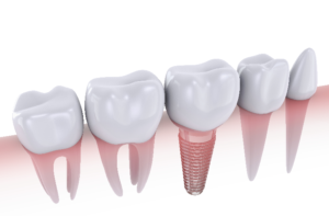digital model of dental implant