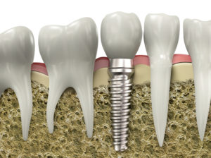 Dental implant in jawbone