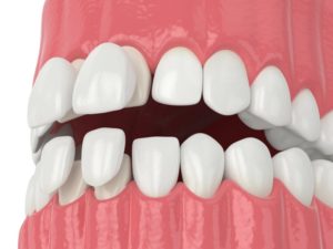 Four porcelain veneers