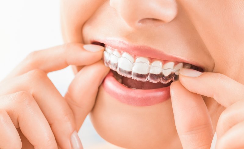 an up-close look at a woman inserting an Invisalign aligner