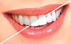 Teeth whitening side-by-side comparison.