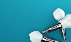 a closeup of dental implants in Herndon