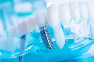 Dental implants in plastic model of mouth