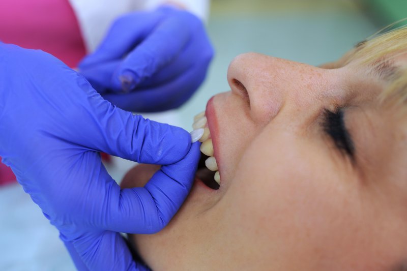 A dentist placing veneers over a woman’s teeth